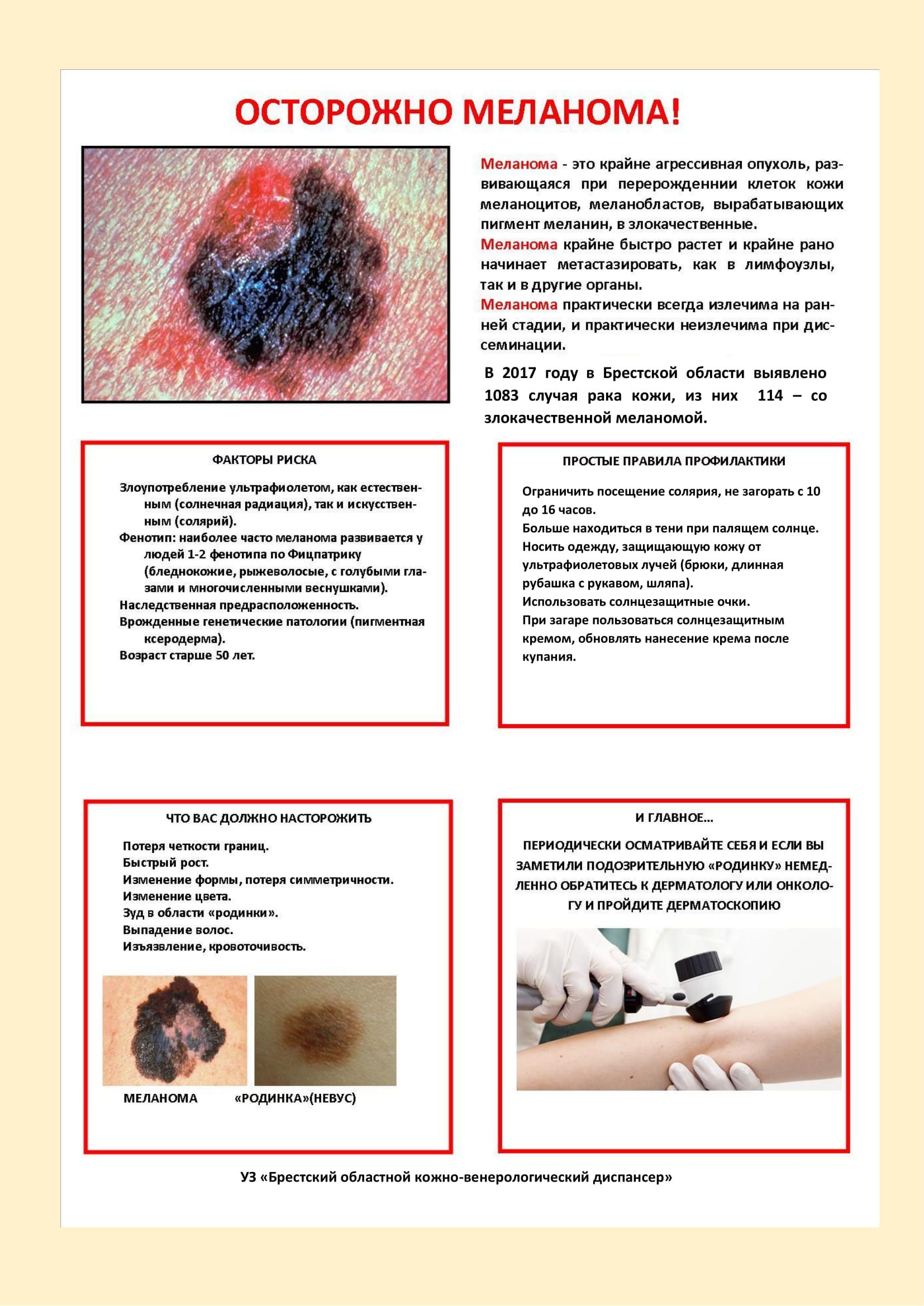 melanoma 